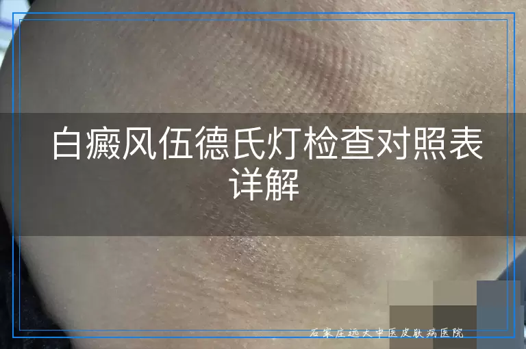 白癜风伍德氏灯检查对照表详解