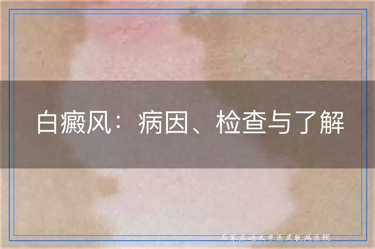 白癜风：病因、检查与了解