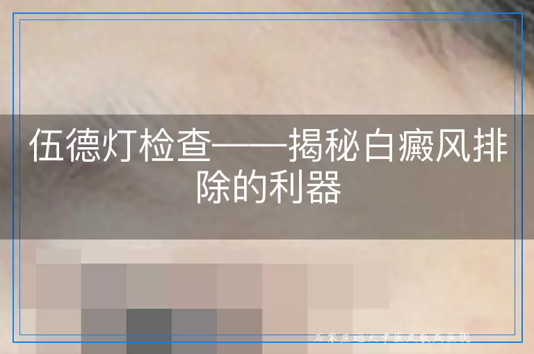 伍德灯检查——揭秘白癜风排除的利器