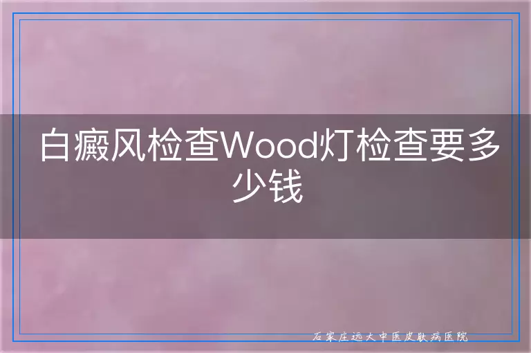 白癜风检查Wood灯检查要多少钱