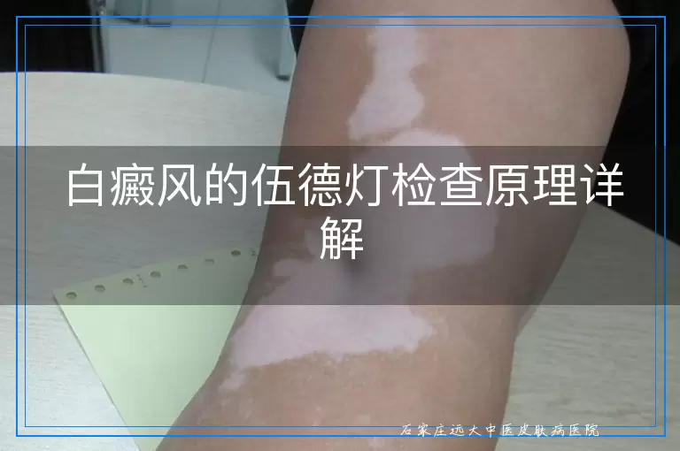 白癜风的伍德灯检查原理详解