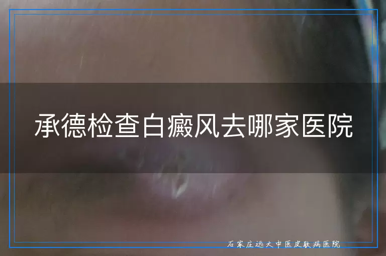 承德检查白癜风去哪家医院