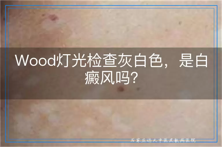 Wood灯光检查灰白色，是白癜风吗？