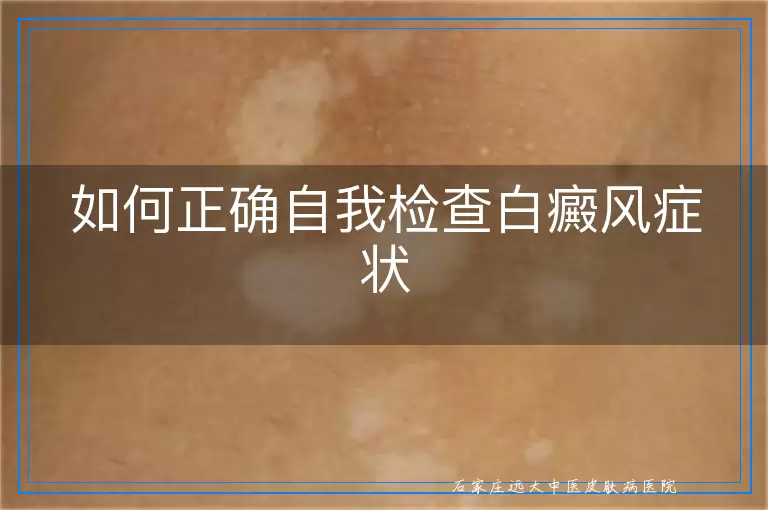 如何正确自我检查白癜风症状
