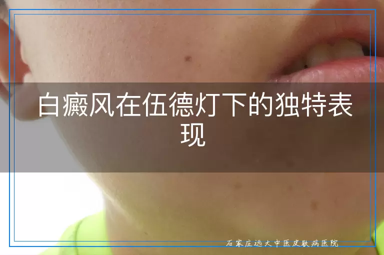 白癜风在伍德灯下的独特表现