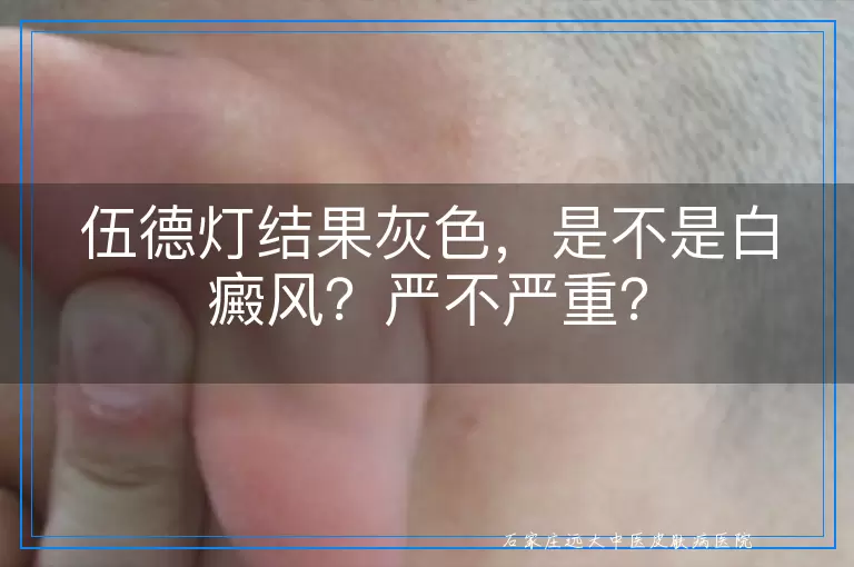 伍德灯结果灰色，是不是白癜风？严不严重？