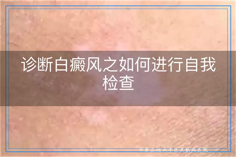 诊断白癜风之如何进行自我检查