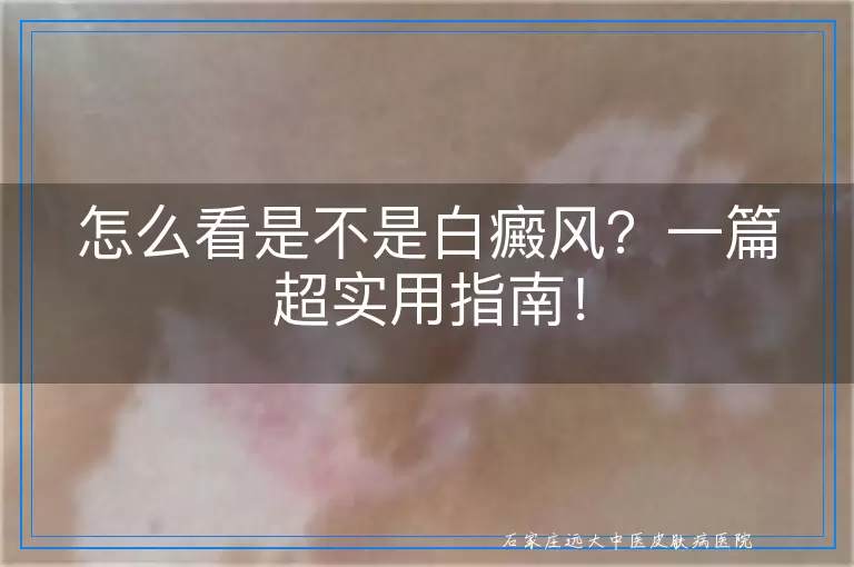 怎么看是不是白癜风？一篇超实用指南！