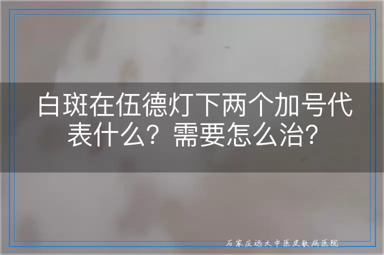 白斑在伍德灯下两个加号代表什么？需要怎么治？