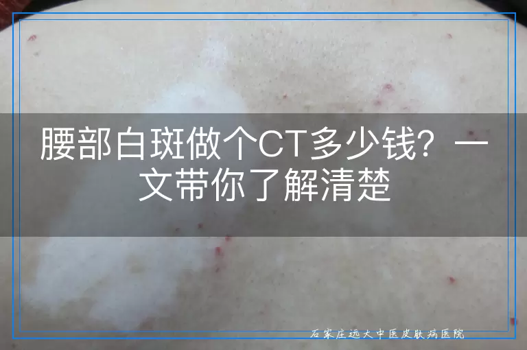 腰部白斑做个CT多少钱？一文带你了解清楚