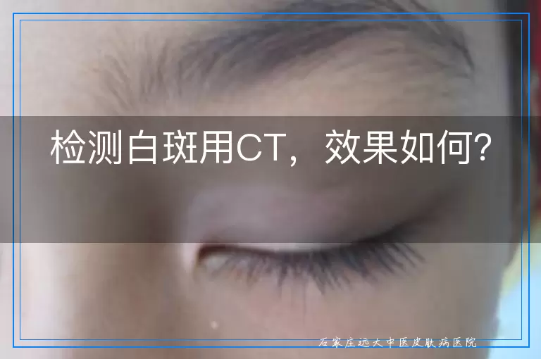 检测白斑用CT，效果如何？
