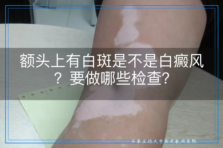 额头上有白斑是不是白癜风？要做哪些检查？