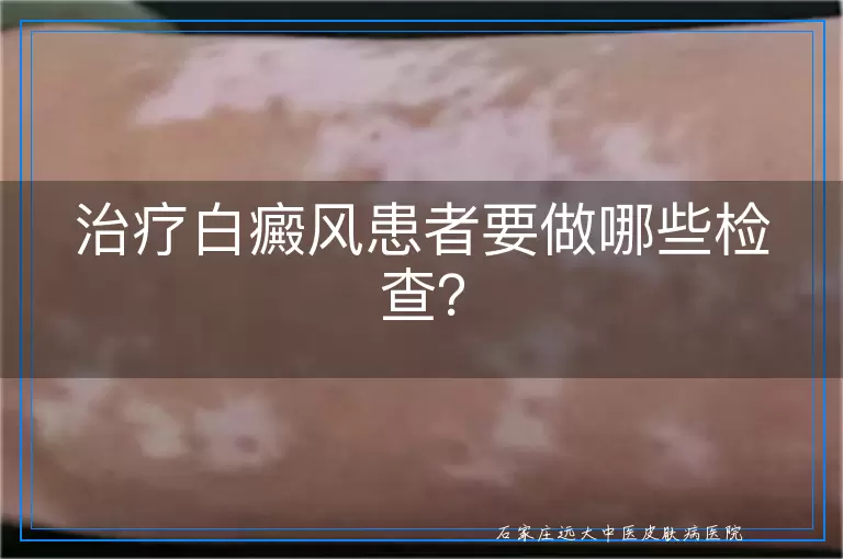 治疗白癜风患者要做哪些检查？
