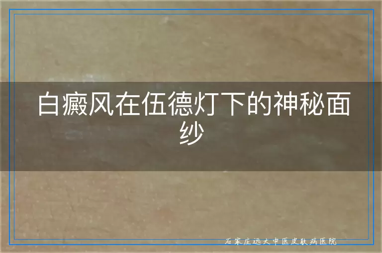 白癜风在伍德灯下的神秘面纱