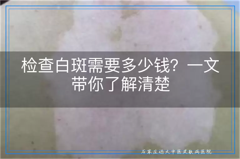 检查白斑需要多少钱？一文带你了解清楚