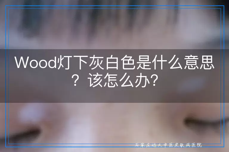 Wood灯下灰白色是什么意思？该怎么办？