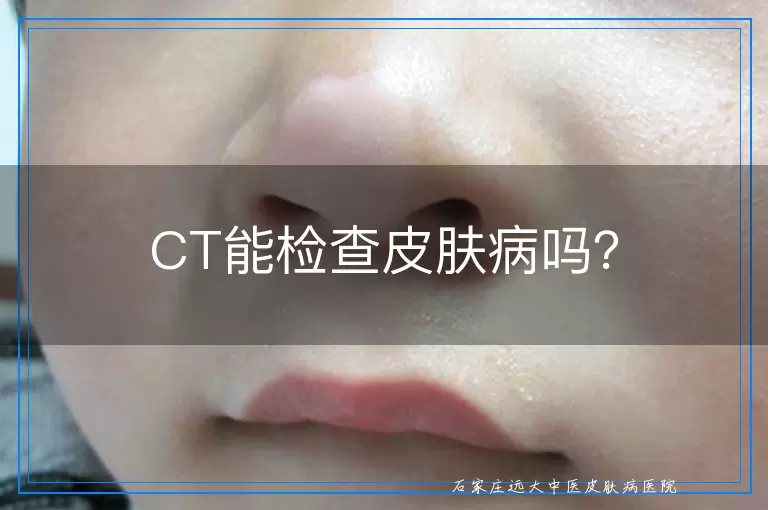 CT能检查皮肤病吗？