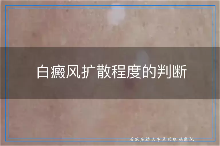 白癜风扩散程度的判断