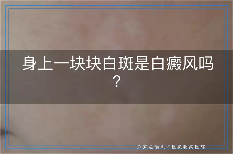 身上一块块白斑是白癜风吗？