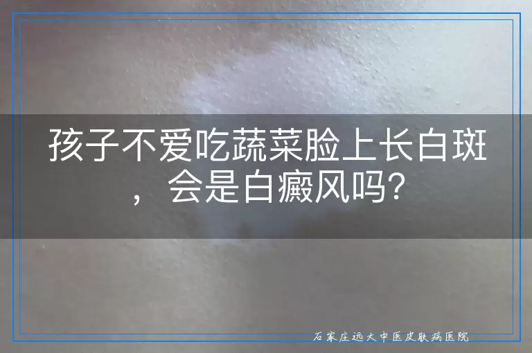 孩子不爱吃蔬菜脸上长白斑，会是白癜风吗？