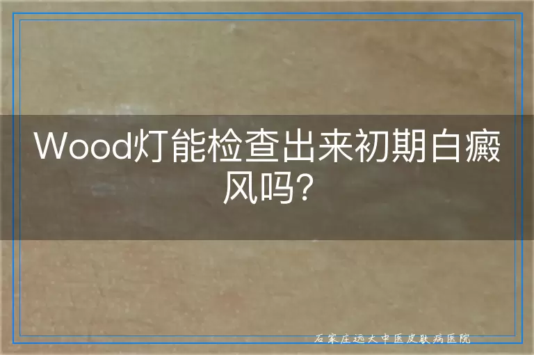 Wood灯能检查出来初期白癜风吗？