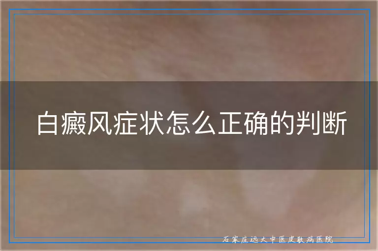 白癜风症状怎么正确的判断