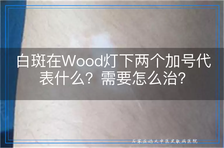 白斑在Wood灯下两个加号代表什么？需要怎么治？