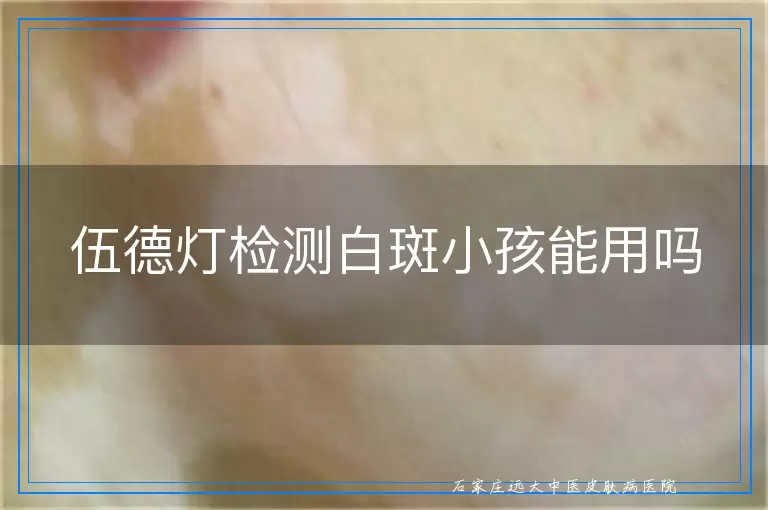 伍德灯检测白斑小孩能用吗