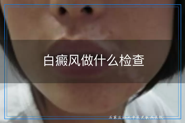 白癜风做什么检查