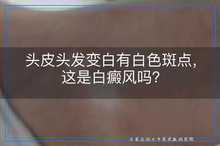头皮头发变白有白色斑点，这是白癜风吗？