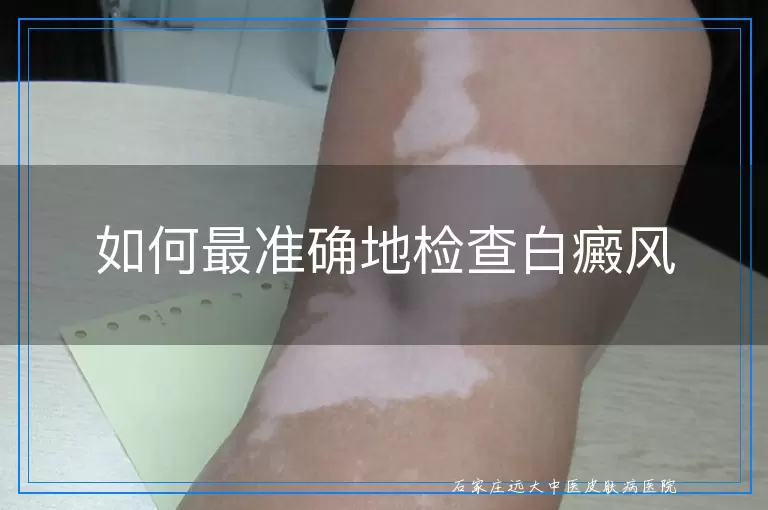 如何最准确地检查白癜风