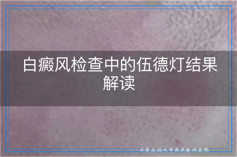 白癜风检查中的伍德灯结果解读