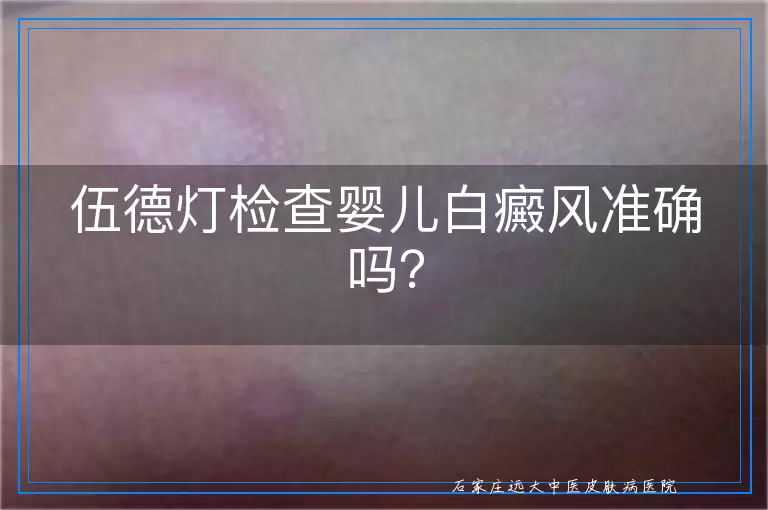 伍德灯检查婴儿白癜风准确吗？