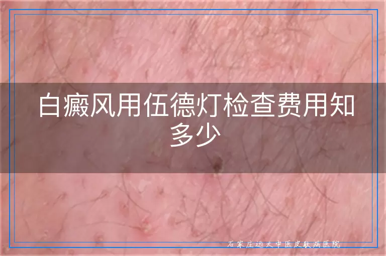 白癜风用伍德灯检查费用知多少
