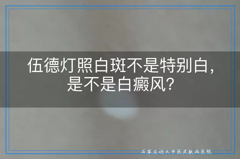 伍德灯照白斑不是特别白，是不是白癜风？