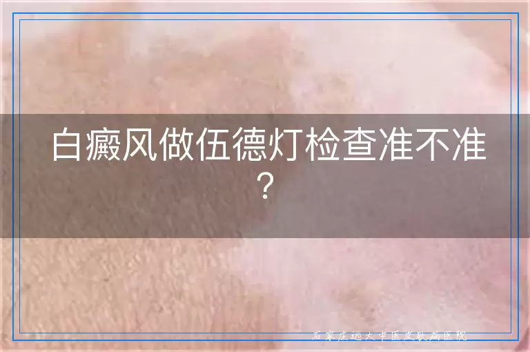 白癜风做伍德灯检查准不准？