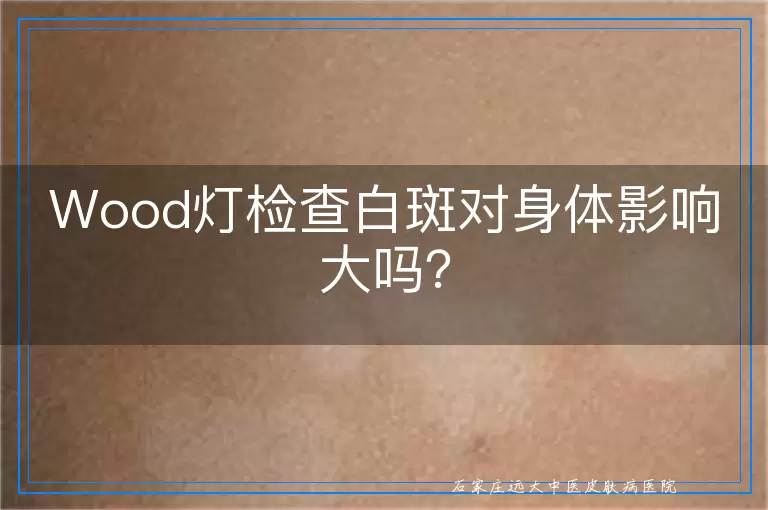 Wood灯检查白斑对身体影响大吗？
