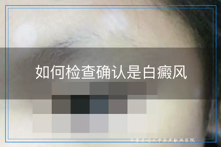 如何检查确认是白癜风