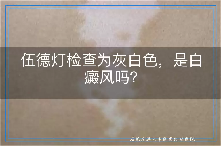 伍德灯检查为灰白色，是白癜风吗？