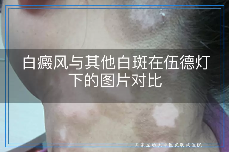 白癜风与其他白斑在伍德灯下的图片对比