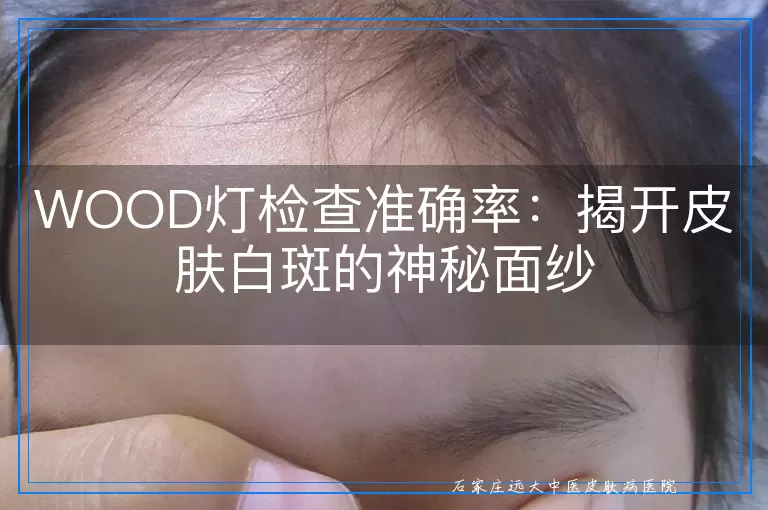 WOOD灯检查准确率：揭开皮肤白斑的神秘面纱