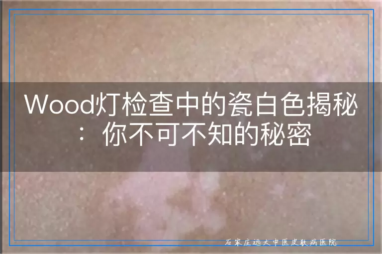 Wood灯检查中的瓷白色揭秘：你不可不知的秘密