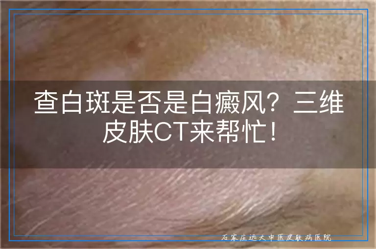 查白斑是否是白癜风？三维皮肤CT来帮忙！