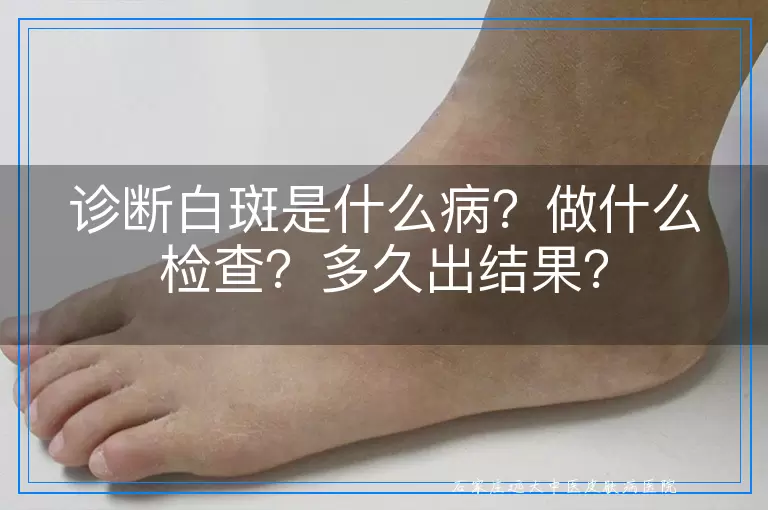诊断白斑是什么病？做什么检查？多久出结果？