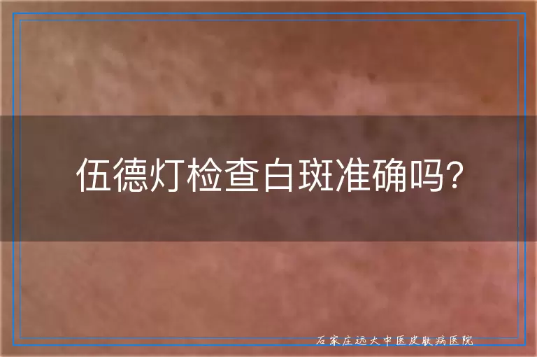 伍德灯检查白斑准确吗？