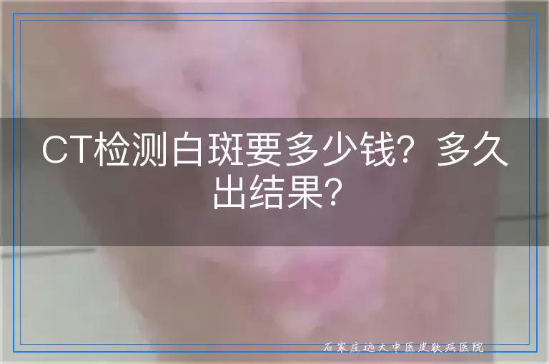CT检测白斑要多少钱？多久出结果？