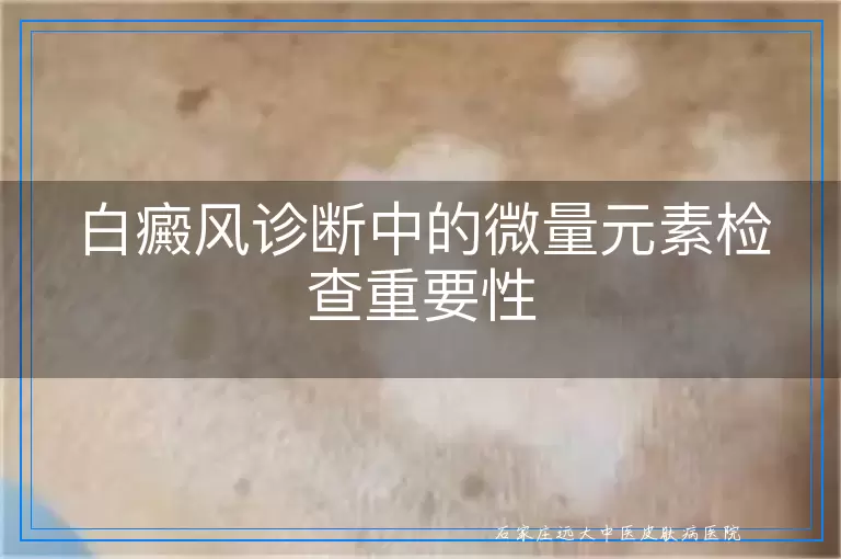 白癜风诊断中的微量元素检查重要性