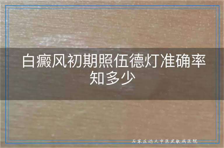 白癜风初期照伍德灯准确率知多少