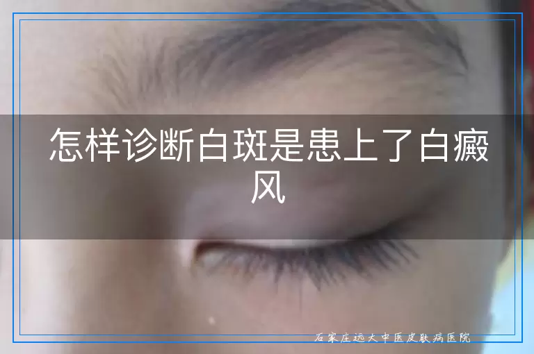 怎样诊断白斑是患上了白癜风