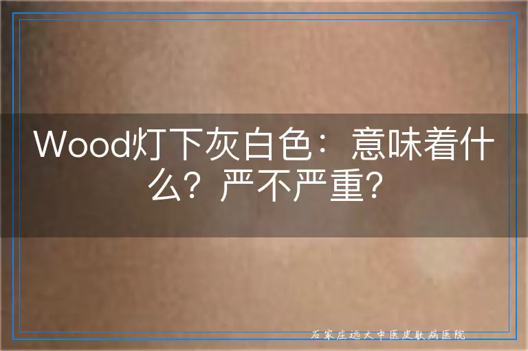 Wood灯下灰白色：意味着什么？严不严重？